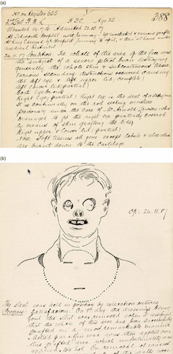 FIGURE 5 Notes from Lumley case file. Reproduced with permission of the Gillies Archives, Queen Mary's Hospital Sidcup.