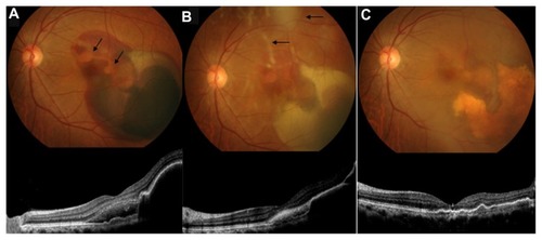 Figure 2 Case 2 fundus photograph and optical coherence tomography imaging of the left eye. (A) At the initial visit to the clinic, the fundus showed submacular hemorrhaging and reddish-orange subretinal nodules corresponding to polypoidal choroidal vasculopathy (arrows). Optical coherence tomography imaging revealed a subretinal hemorrhage and elevation of the retinal pigment epithelial layer. (B) Five days after gas injection, there was displacement of the hemorrhage towards the downward region of the eye and absorbance of a part of the submacular hemorrhage. The displaced hemorrhage became coagulum. Slight vitreous haze was observed (arrows). The elevated retinal pigment epithelial layer was still observable by optical coherence tomography. (C) Two months after gas injection, the submacular hemorrhage disappeared and the vitreous haze was mostly absorbed.