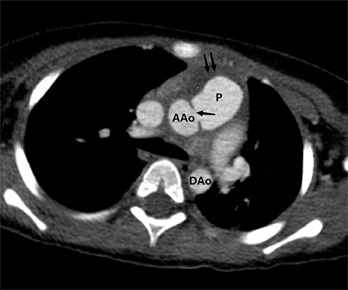 Figure 3 Axial contrast-enhanced CT image revealing the ascending aortic pseudoaneurysm with intraluminal thrombus formation. Single arrow: rupture site; Double arrows: mural thrombus.
