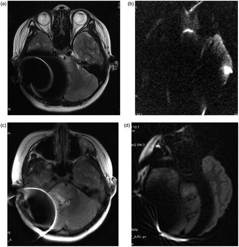 Figure 2. A: Conventional T2 sequence: the magnet artifacts covered up most of the lesion areas. B: Propeller T2 sequence: the magnet artifacts decreased significantly. The lesions presented high signal in Propeller T2 sequence C: Conventional DWI sequence: Because the DWI is an EPI sequence, it is very sensitive to the local magnetic field inhomogeneity caused by metal. This results in severe deformation of conventional DWI, heavy metal artifacts, and completely blocks the image of the lesion. D: Propeller DWI sequence reducing metal artifacts. The image is basically without deformation, although there is interference of metal artifacts in cochlea, it can still be observed that the lesions presented high signal.