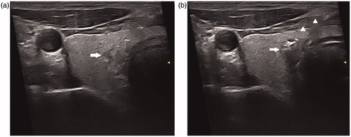 Figure 1. (a) A 45-year-old man had a suspicious hypoechoic lesion (arrow) measured 5.3 × 3.7 × 3.0 mm in the right thyroid lobe. (b) A 300-m plane-cut optic fiber was inserted through the introduced needle (arrow head). During the ablation, the typical hyperechoic region (arrow) occurred surrounding the tip of the fiber due to formation of gas.
