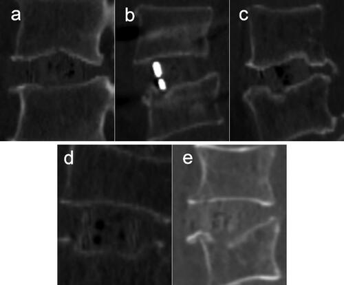 Figure 3. The patterns of intraoperative endplate injury during LLIF procedures. (a) Endplate abrasion, without cage settling. (b) one edge of the cage settles into the vertebral body. (c) two diagonal edges of the cage settle into the vertebral bodies. (d) the upper or lower surface of the cage settles into the vertebral body. (e) Fracture of the superior or inferior vertebral body, the fracture line is distributed along the coronal plane.