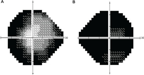 Figure 2 (A) Grayscale visual field testing of the left eye; (B) grayscale visual field testing of the right eye (Carl Zeiss Meditec AG, Jena, Germany).
