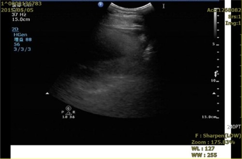 Figure 4 Pericardial effusion-volume changes seen on an ultrasonogram obtained on May 5, 2015 (5 months after bevacizumab treatment).