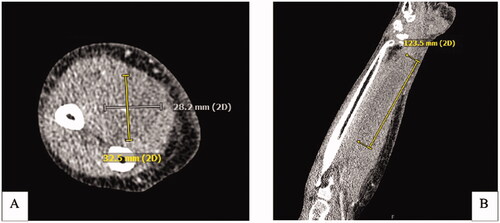 Figure 3. CT Right upper extremity with IV contrast. (A) Axial CT demonstrating a hypodense nonenhancing intramuscular collection within the volar compartment measuring at least 12.3 × 3 × 3 cm. (B) Coronal view of intramuscular collection.