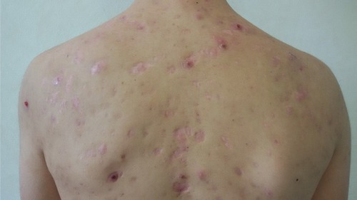 Figure 2 Regression of inflammatory nodules after 16-week isotretinoin treatment resulting in atrophic scars.