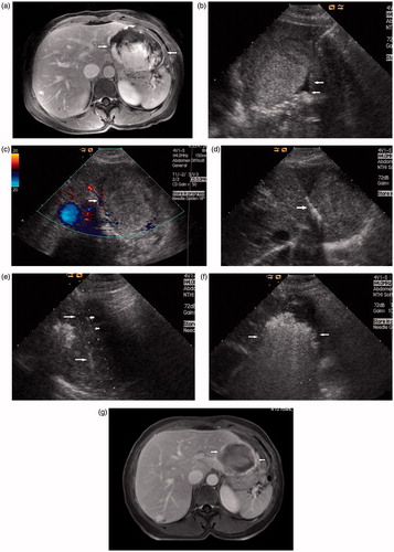 Figure 2. Images in a 50-year-old-woman who underwent MWA for hepatic cavernous haemangioma 8.8 cm in diameter. (a) Preoperative contrast-enhanced MRI showed the haemangioma was hyperenhanced in portal vein phase in left lobe and abutting the stomach (arrow). (b) The injection of normal saline (arrow) to separate the tumour and the stomach. (c) Colour Doppler ultrasonography depicts feeding arteries entering the tumour on the right side (arrow). (d) The antenna was inserted to ablate the feeding arteries (arrow). (e) US image showed the second antenna (long arrow) and the PTC needle (short arrow) were placed in the tumour. (f) US image showed the hyperechoic area of ablation covered the tumour (arrow). (g) Postoperative contrast-enhanced MRI showed complete necrosis of the tumour and the maximum diameter was reduced to 5.8 cm 3 days after MWA (arrow).