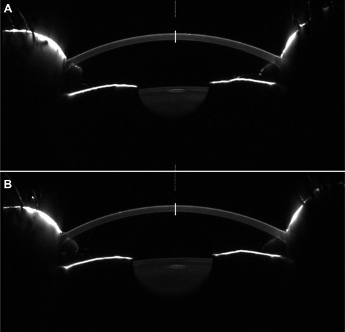 Figure 1 Scheimpflug photography was used to determine the changes of corneal light backscattering in all subjects.
