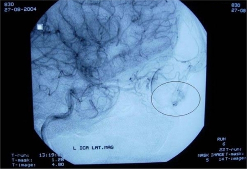 Figure 2 Increased vascular permeability and contrast extravasation on left external carotid and ophthalmic artery angiography.