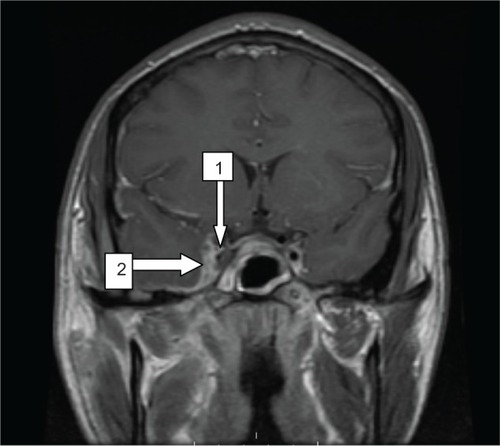 Figure 1 A band of enhancement measuring 6 mm in thickness is seen along the medial margin of the right temporal convexity (arrow #2). Increased T2 signal in the region of the right cavernous sinus with diminshed enhancement is suggestive of cavernous sinus thrombosis (arrow #1).