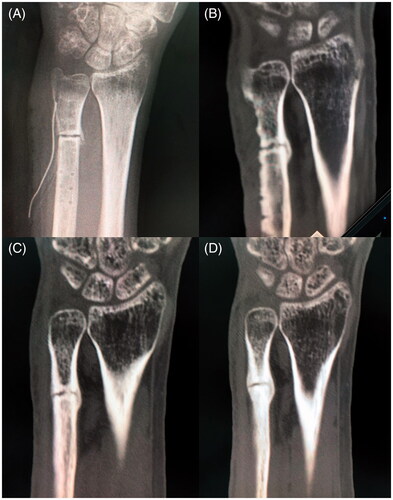 Figure 2. (A) Postoperative X-ray (immediately after implant removal and debridement). (B) Postoperative computed tomography (CT, 1 month after implant removal and debridement). There was poor callus formation and a bony absorption at the osteotomy site. (C) Postoperative CT (4 months after implant removal and debridement and 3 months after the start of teriparatide therapy and low-intensity pulsed ultrasound [LIPUS]). (D) Postoperative CT (5 months after implant removal and debridement and 4 months after the start of teriparatide therapy and LIPUS). Bony union at the osteotomy site was observed.