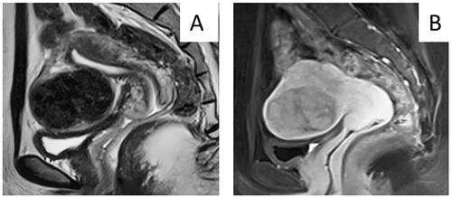 Figure 5. MR images obtained from a 32-year-old patient who reported no abnormal vaginal bleeding. A. T2WI showed a hypointense tumor with clear boundary. B. Contrast-enhanced MRI showed mild enhancement of tumor. According to the nomogram chart, the scores for no abnormal vaginal bleeding clear margin of tumor, low signal intensity on T2WI, and weak enhancement were 0, 0, 0, and 20 points. The total score was 20 points. The final diagnosis was uterine fibroids after surgery.
