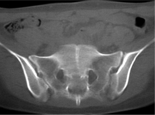 Figure 2. CT scan at 9 months showing healed fracture line.