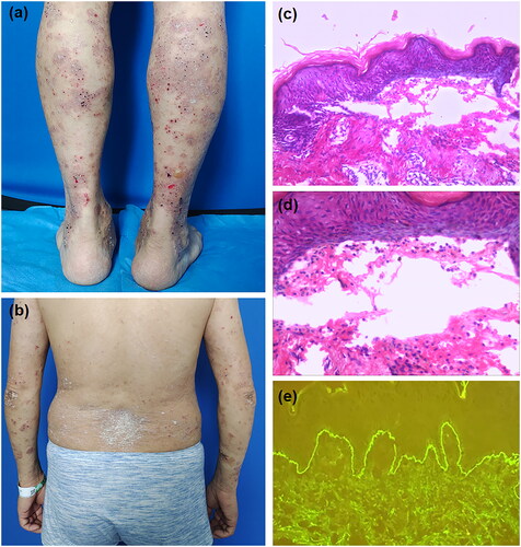 Figure 1. (a) Scattered thick-walls vesicles based on erythematous on the lower limbs, with some small superficial erosions and crusts. (b) a few scattered red plaques covered with silvery white scales are seen on the back and upper limbs. (c) Histopathology examination shows subepidermal blisters. (d) Small number of eosinophils were seen within the blisters. (e) Direct immunofluorescence studies reveal linear deposition of IgG at the basement membrane zone.