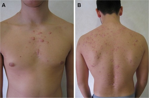 Figure 3 At follow-up visit 6 months after therapy cessation, no sign of relapse was observed. Some keloid scars developed on the chest (A) and shoulders (B).