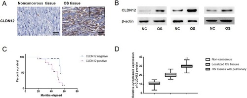 Figure 2 The expression of CLDN12 in patients with osteosarcoma and noncancerous tissues were explored via IHC and western-blotting. (A) Detection of CLDN12 in primary osteosarcoma tissues and noncancerous tissues. (B) Protein expression of CLDN12 in human primary osteosarcoma tissues and noncancerous tissues. (C) Kaplan-Meier Survival Curves and the log rank test were used in the analysis of the association between CLDN12 and survival time. (D) The corresponding statistical analysis of CLDN12 protein expression in human primary osteosarcoma tissues and noncancerous tissues. **P<0.01.Abbreviations: CLDN12, claudin-12; NC, Noncancerous tissues; OS, osteosarcoma tissues.