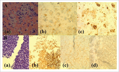Figure 2. Histopathology and Immunohistochemical (IHC) Staining of Sequentially-Occurred NSCLC (ADC) and SCLC. Panel A: Histopathology and immunostaining of ADC of lung (Lymph node aspiration cytology). (a). H and E staining showing scattered enlarged cells with vesicular chromatin, visible nucleoli and moderately fine vacuolated cytoplasm. (b). IHC staining showing positive cytoplasmic stain for MOC31 (MOC31 is an immunological marker used for differentiation between metastatic ADC and lung mesothelioma where ADC is positive and mesothelioma is negative for MOC31). (c). IHC staining showing positive staining for CD15 (CD15 is a carbohydrate antigen on cells and can help during the confirmation process of lung ADC by differentiating it from mesothelioma which is negative for CD15 immunological staining). Panel B: Histopathology and immunostaining of transformed SCLC (Liver Biopsy). (a). H and E staining showing a diffuse infiltrate of polygonal neoplastic cells with a high nucleus to cytoplasm ratio, hyperchromatic nuclei, fine chromatin, inconspicuous nucleoli and focally forming vague pseudorosettes. (b). IHC staining showing positive cytoplasmic staining for synaptophysin. (c). IHC staining showing positive staining for CD56. (d). IHC staining showing very weak patchy staining for P63 (P63 is a nuclear marker used for immunostaining to differentiate squamous cell CA from ADC and is very strongly positive for SCC in contrast to ADC of the lung).
