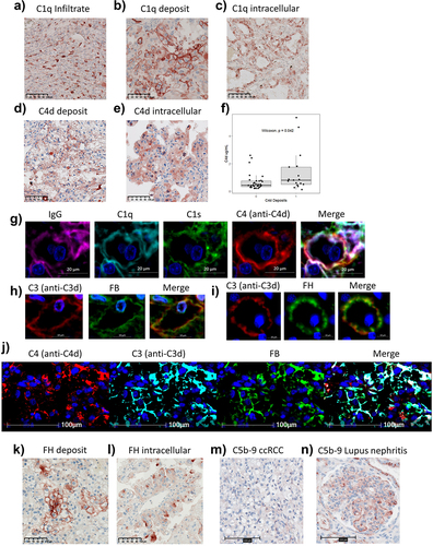 Figure 3. Complement proteins are found at the tumor cell membrane and intracellularly. immunohistochemistry against C1q highlighted staining (a) in immune cells, (b) at the tumor cell membrane, and (c) intracellularly in tumor cells. Immunohistochemistry against C4d highlighted staining (d) at the tumor cell membrane, and (e) intracellularly in tumor cells. (f) association between the concentration of C4d in plasma and the presence of C4d at the surface of tumor cells intratumorally determined by Wilcoxon rank sum test. (g) immunofluorescence multiplex showed colocalization of IgG, C1q, C1s, and C4d at the surface of tumor cells. Immunofluorescence multiplex showed co-localization of (h) C3 and FB, and (i) C3 and FH at the surface of tumor cells. (j) immunofluorescence multiplex showed colocalization of C4, C3 and FB. Immunohistochemistry against FH highlighted staining (k) at the tumor cell membrane, and (l) intracellularly in tumor cells. Immunohistochemistry against C5b9 in (m) ccRCC primary tumor, and (n) lupus nephritis glomerulus.