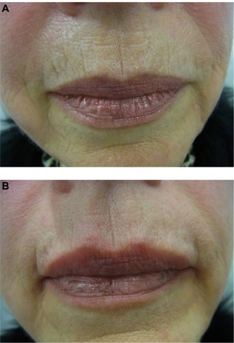 Figure 4 A 67-year-old woman with perioral fine lines and flattening of philtrum collumelas.