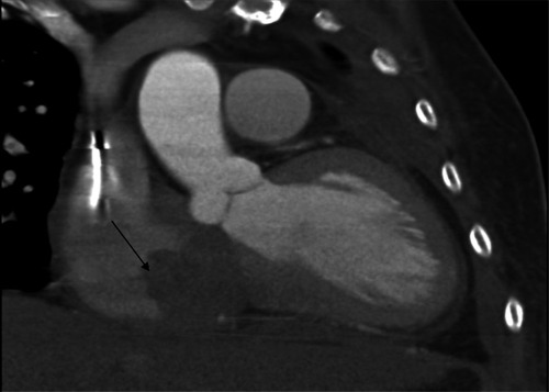 Figure 4 A multislice computed tomogram showing a bulky infiltrative mass about 8.62 cm × 6.45 cm × 9 cm at posterior-lateral and inferior aspect of the left atrium with invasion to myocardium, the interatrial septum, tricuspid valve, right atrium, pericardium, left hilar region, and left pleura (arrow).