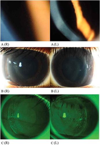 Figure 2. Ocular findings showing corneal A: microcystic responses, B: corneal haze, and C: corneal staining when first noted. R-right eye, L-left eye. Images captures using Topcon slit-lamp biomicroscopy (SL-D7, Topcon Medical Systems Inc., Oakland, USA)