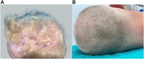 Figure 5 Example of soft/thin scalps. Top view of patient 5 (man of North European descent) possessing soft/thin scalp, showing fine hair (A). Posterior view of patient 5, after shaving in preparation for FUE, manifesting high hair density (B).
