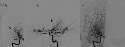 Figure 2 DSA images demonstrates a “puff of smoke” sign (A and B) (black arrows) and reveal unilateral moyamoya syndrome with unilateral disease on the right internal carotid artery which is nearly occluded (C), hypervascularity of the lenticulostriate vessels, and transdural collateral supply, indicative of advanced disease progression.