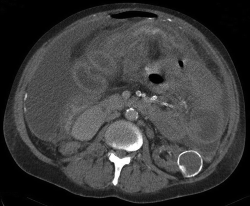 FIGURE 2. CT abdomen demonstrates nodular peritoneal thickening and peritoneal calcification. There are free fluid and loculated fluid collections on the left. The bowel loops are centrally located.