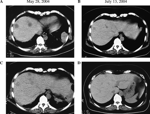 Figure 3.  Multiple metastatic tumors in the liver (A and C) were observed. By treatment with low dose chemotherapy and immunotherapy, not only the primary lung cancer, but also the multiple liver metastases diminished significantly (B and D).