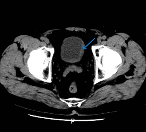 Figure 2 CT of the bladder: the blue arrow marks the location of the patient’s bladder wall thickening.