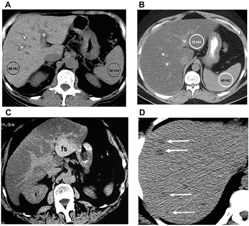 Figure 4 CT scan of liver in healthy persons and overweight diabetic as well as class I and II obese patients. Normal appearance of the liver at unenhanced CT (A). CT of overweight diabetic patients showed diffuse fat accumulation in the liver (B). Also, Focal fat accumulation in the liver at CT in class I obese diabetic patients (C). In addition, CT liver examination of class II obese diabetic patients showed multifocal fat accumulation in the liver at CT (D).