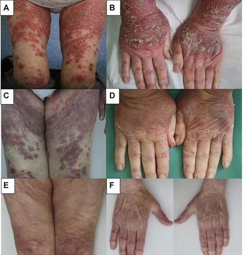 Figure 1 Case 1 (A and, B) widespread erythematous plaques and coalescing pustules on day 0; (C and, D) widespread postinflammatory hyperpigmentation with residual erythema and exfoliation on the distal parts of the upper limbs at week 2; (E and, F) almost-clear skin with discrete residual erythema on the dorsa of the hands at week 18.