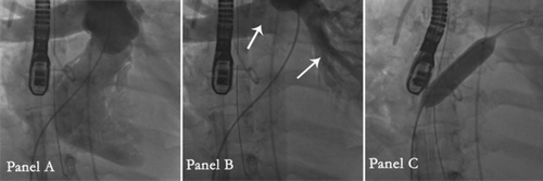 Figure 1. The right heart catheterization (Panel A) with the stagnation of iodine contrast in the trunk of the pulmonary artery and its branches (Panel B, white arrows); The 10 mm Marshal balloon inflated in the atrial septum (Panel C).