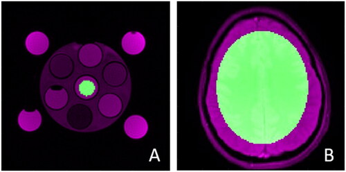 Figure 4. ROIs chosen for MRT evaluations. (A) shows the ROI for the phantom: only the vial in the center containing water mixture was selected; and (B) for the volunteers: encompassing an elliptical volume of brain tissue, as large as possible while constant among all volunteers.