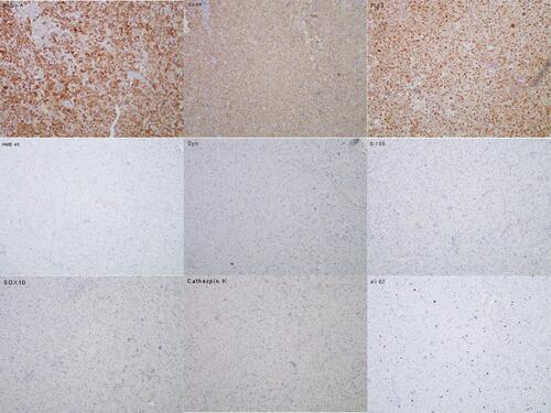 Figure 3 Immunohistochemistry of the perirenal mass showed positive for Melan-A, cluster differentiation (CD)56, and TFE3, while negative for HMB45, Syn, S-100 and SOX10. Ki67 was present in approximately 1% of tumor cells.