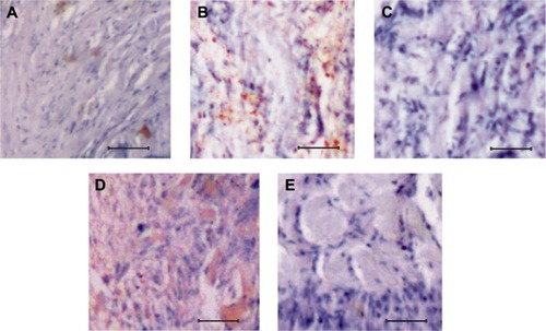 Figure 3 Analysis of TCTP expression in normal and osteosarcoma tissues.
