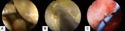 Figure 8 The stone was visualized with 30 Fr rigid nephroscope (A) and fragmented with combination of pneumatic and shock pulse lithotripters (B). There was no residual stone after the PCNL procedure (C).