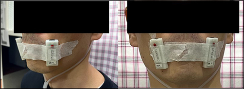 Figure 2 Images to demonstrate how the participants slept with their mouths sealed by the breathable tape throughout the night.
