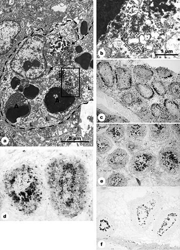 Figure 2.  BSDCs and T cells during IBDV infection. 2a: 5-FU and IBDV inoculation (group 3): 2 days after IBDV infection. The cell contains apoptotic lymphocytes (A) and two demarcated bodies, in which the virus particles are associated with an electron-dense substance (arrow). Part of one of the demarcated bodies is outlined and shown in 2b. Lipid droplets (L) in the cytoplasm. Magnification, 10 000×. 2b: Detail from 2a. In the demarcated body, the virus particles are intermingled with electron dense substance. Magnification, 40 000×. 2c: IBDV inoculation (group 2): 3 days p.i., CD3-positive T cells aggregate in the follicular cortex. Medulla contains only scattered T cells. Magnification, 140×. 2d: IBDV inoculation (group 2): 2 days p.i., the 74.3-positive BSDCs aggregate along the cortico-medullary border in several follicles. Magnification, 160?×. 2e: IBDV inoculation (group 2): 3 days p.i., the 74.3-positive BSDCs seem to be completely aggregated in the medulla. Magnification, 140×. 2f: IBDV inoculation (group 2): 2 days p.i., the anti-IgG staining confirm observations obtained by 74.3 monoclonal antibodies. The IgG-positive BSDCs aggregate along the cortico-medullary border. Compare with 2d. Magnification, 70×.