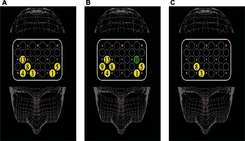 Figure 6 Cortical distribution of significant correlations between activation and PANSS scores. (A) In TMT-A, oxy-Hb changes at six channels showed a significant negative correlation with positive symptom scores. (B) In TMT-B, oxy-Hb changes at six channels showed a significant negative correlation with positive symptom scores. Oxy-Hb changes at ch 10 showed a significant negative correlation with negative symptom scores. (C) In B–A activation, the values at two channels showed a significant correlation with positive symptom scores.