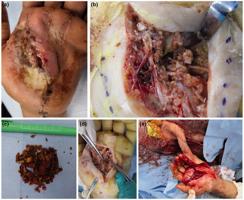 Figure 6. (a) Extensive necrosis is observed around the wound. (b) Debridement of the necrotic epidermis reveals residual paint in the carpal tunnel. (c) The extracted paint is shown. A large amount of cured paint was also observed during the third operation. (d) After debridement, a fan-shaped skin defect is seen in the hand. (e) Reconstruction was performed with a pedicled groin flap.