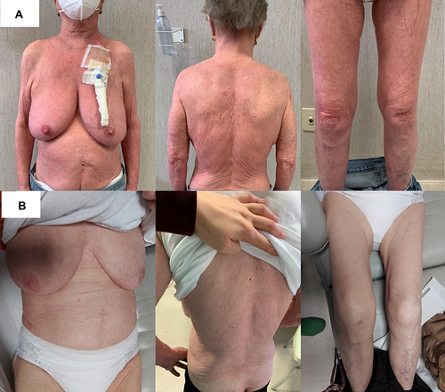 Figure 6 Skin involvement before (A) and after (B) therapy with mogamulizumab.