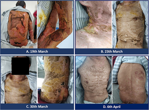 Figure 2 Clinical photograph of the patient recovering from SJS. (A) On March 19, 2020, the patient’s skin exudation began to decrease. (B) On March 23, 2020, the patient’s skin gradually became dry and started to heal. (C) On March 30, 2020, the patient’s skin further healed and was dry without exudation, with only a small amount of bright red skin exposed on the buttocks. (D) On April 6, 2020, the patient’s skin damage was significantly healed.