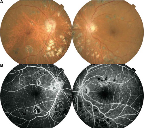 Figure 1. Fundus photographs in February 2014 (A) and fluorescein angiography in April 2014 (B).