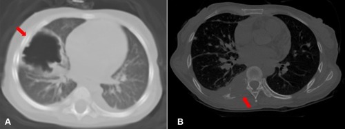 Figure 1 High-resolution computed tomography. High-resolution computed tomography showing a cavitary lesion (arrow) (A) and osteolytic lesions in the ribs accompanied by soft tissue swelling (B).