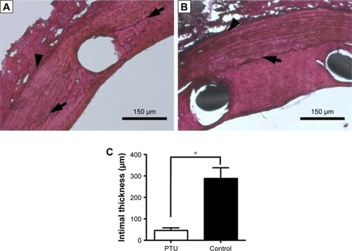 Figure 4 Neointimal formation in the descending aortas of rabbits after intervention.Notes: Representative photomicrographs of rabbit aortas with (A) or without (B) PTU loading (25 μg/mm2) at Week 8 are shown. Magnification ×100. Intimal thickness was counted and averaged (C). Each value represents the mean ± SE of measurements from six rabbits. *Represents significant difference. Arrows denote the internal elastic lamina, and arrowheads denote the external elastic lamina.Abbreviations: PTU, propylthiouracil; SE, standard error.