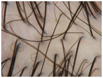 Figure 2 Androgenetic alopecia: hair diameter variability.