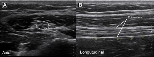 Figure 1 Ultrasound appearance of normal nerves. Ulnar nerve imaged in axial/cross-sectional view with “honeycomb” pattern (A) and longitudinal view with “tram track” pattern (B).
