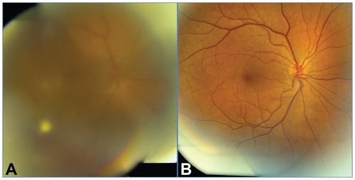 Figure 1 Patient 3, a 50-year-old female with a history of osteomyelitis and chronic intravenous antibacterial treatment. (A) Fundus at presentation. Visual acuity 20/80. Systemic candidemia and endogenous Candida albicans endophthalmitis OD. (B) Fundus 11 months after presentation. Patient treated with intravitreal amphotericin B and systemic fluconazole. Visual acuity 20/20.