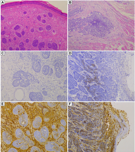 Figure 1 Representative imaging of H&E staining and immunohistochemical staining of CD133 and CD44 in BCC and TB cases. H&E staining shows: (A) uniform cell structure and no infiltrative growth pattern, with a pushing edge, minimal cellular pleomorphism, and sparse mitosis in a TB case; (B) infiltrative growth pattern of BCC into the striated muscle, with marked cellular pleomorphism and active mitosis; Immunohistochemical staining of CD133 in TB (C) and BCC (D) cases, and of CD44 in TB (E) and BCC (F) cases, respectively.